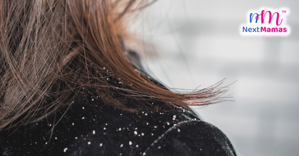How to Get Rid of Dandruff | Dandruff Causes and Treatment | NextMamas - NextMamas