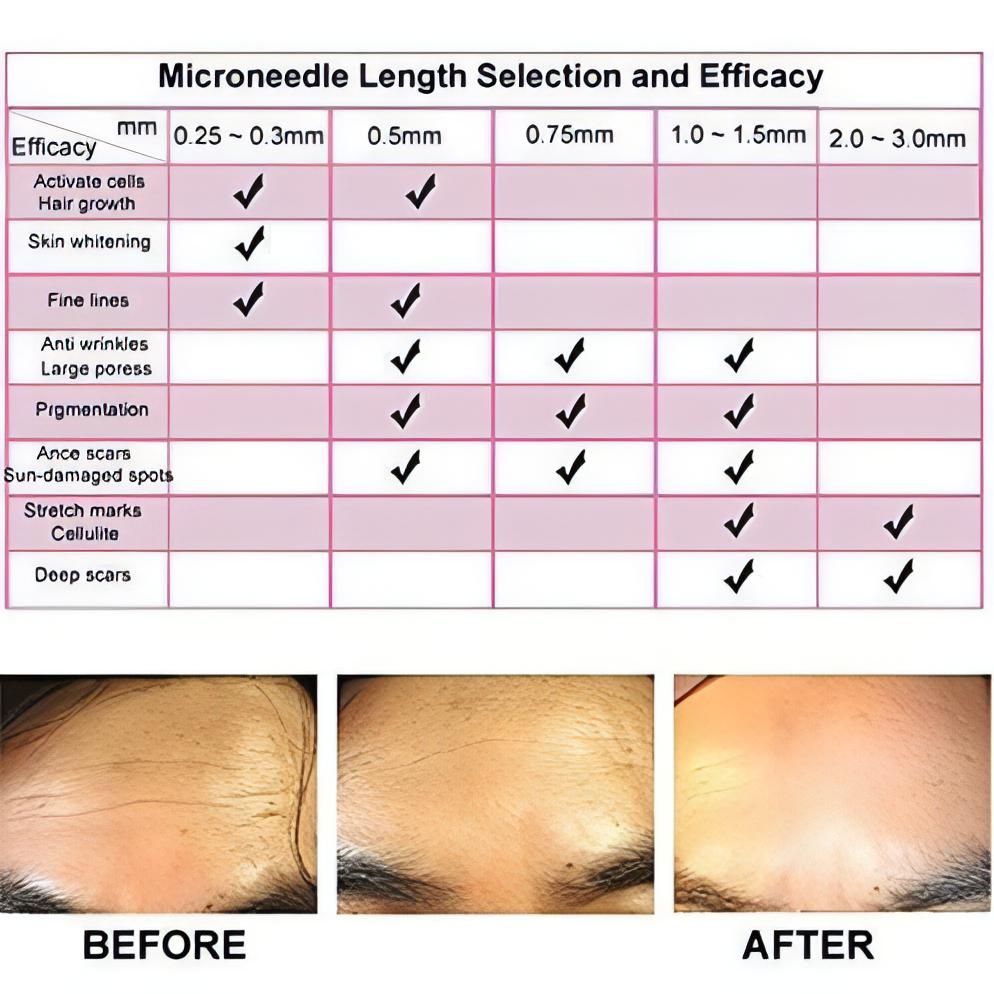 Premium Gold Titanium Micro Needles Derma Roller | For Face Lift, Stretch Marks, Glowing Skin &amp; Scar Treatment - NextMamas